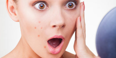 5-ways-for-acne-treatment-at-home