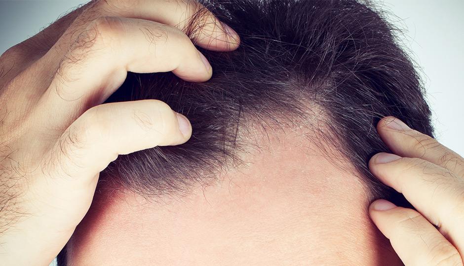 Pygeum-benefits:-Preventing-hair-loss